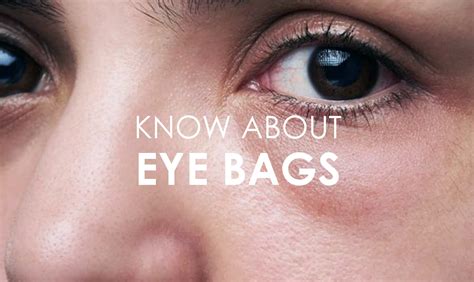 What Does Eye Bags Indicate